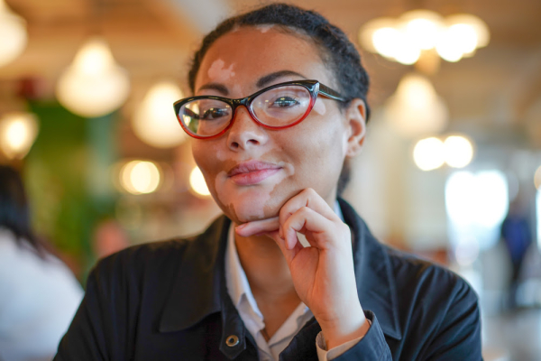 Dia Mundial do Vitiligo: preconceito é a maior luta a ser enfrentada pelos pacientes, destaca especialista