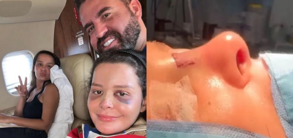 Cantora Maraísa, da dupla com Maiara, sofre acidente e quebra o nariz em Alagoas
