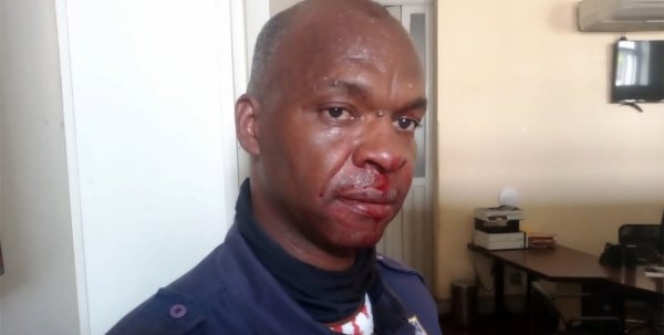Guarda Municipal agredido teve lesão no nariz