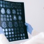  Neuromielite óptica: diagnóstico precoce é essencial e pode salvar vidas 