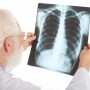 Diagnóstico precoce de tuberculose pode ser feito por exames laboratoriais e de imagem  