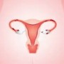 Endometriose: Diagnóstico correto por ressonância magnética garante tratamento eficaz  