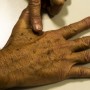 Tecnologia para tratar câncer de pele é aprovado para uso no SUS